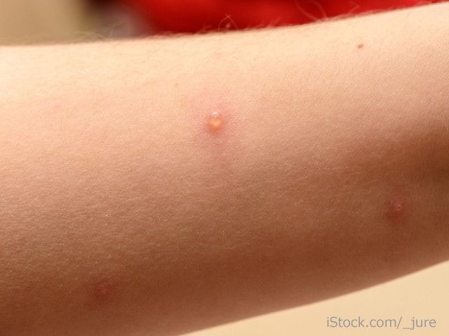 赤ちゃんに発疹が出た その原因と対処法は たまひよ